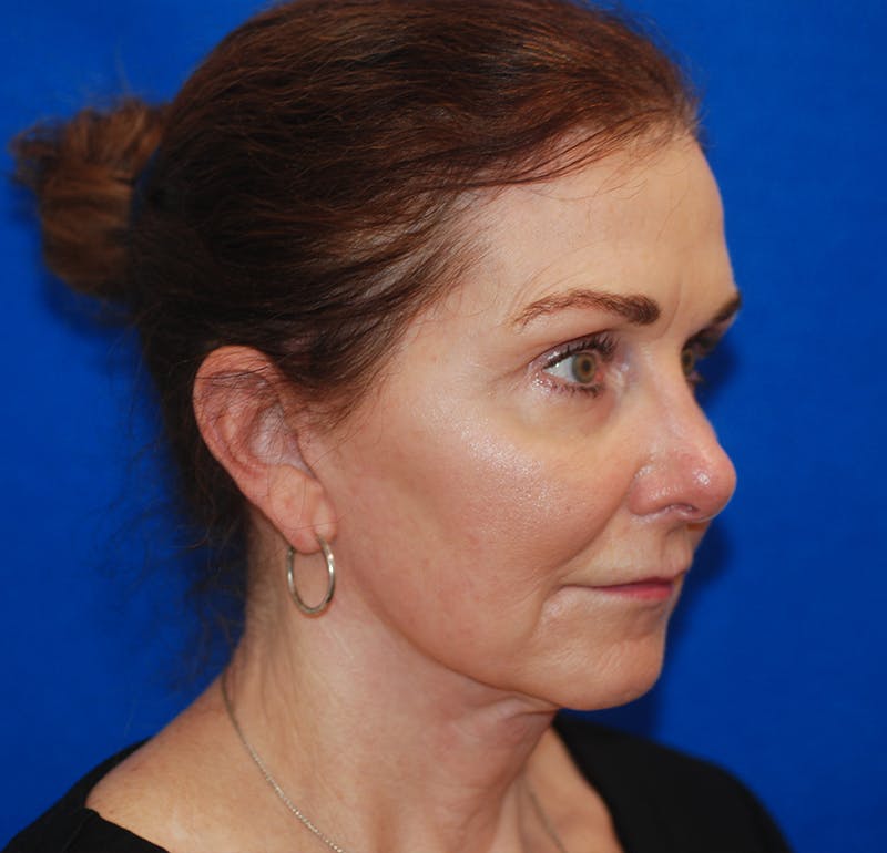 Brow Lift Before & After Gallery - Patient 119147325 - Image 6