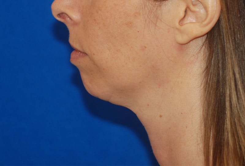 Chin Implant Gallery - Patient 83202842 - Image 1