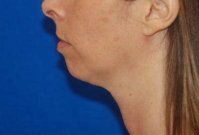 Chin Implant Before & After Gallery - Patient 83202842 - Image 1
