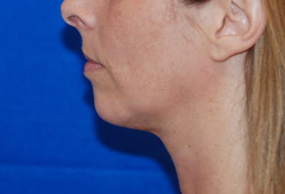 Chin Implant Before & After Gallery - Patient 83202842 - Image 2