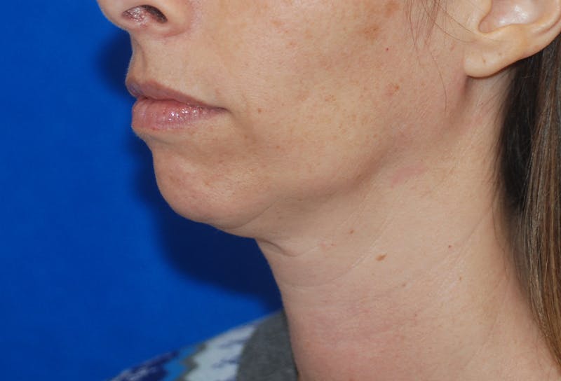 Chin Implant Gallery - Patient 83202842 - Image 3