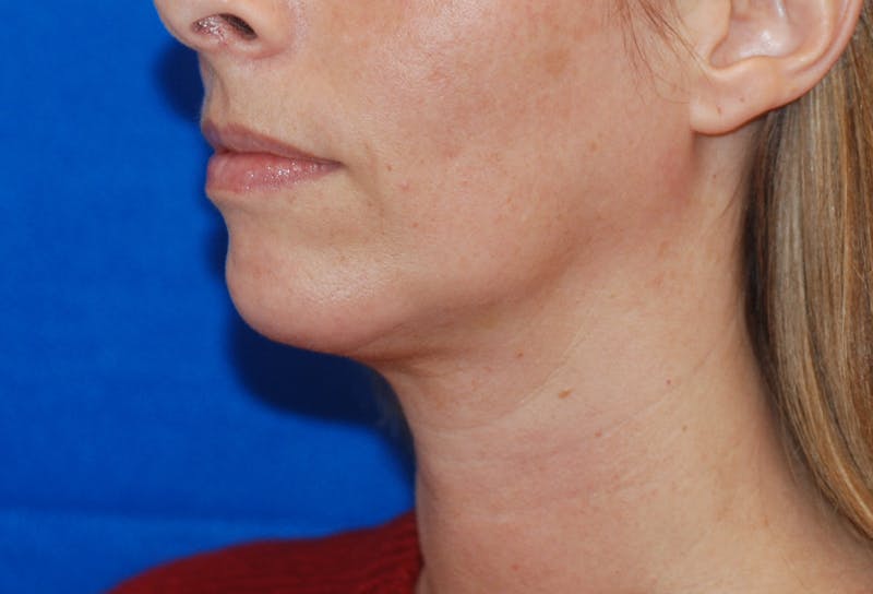 Chin Implant Gallery - Patient 83202842 - Image 4