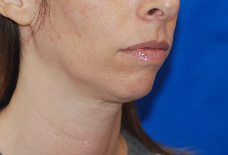 Chin Implant Gallery - Patient 83202842 - Image 5