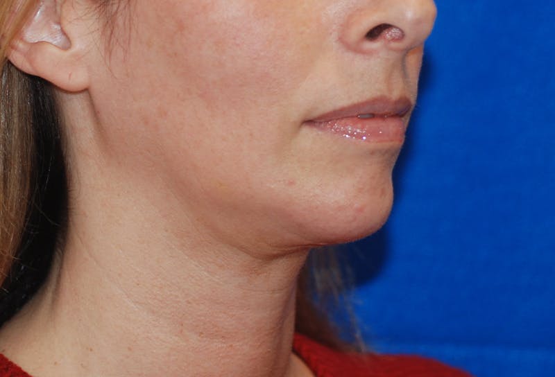 Chin Implant Before & After Gallery - Patient 83202842 - Image 6