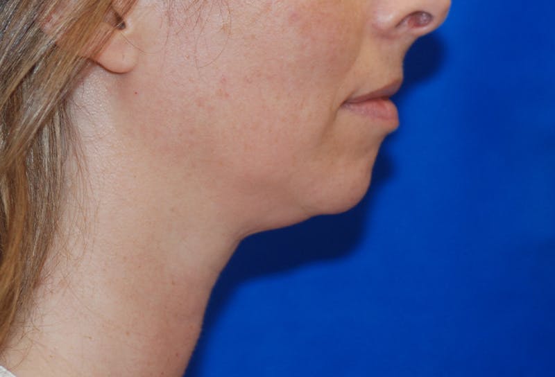 Chin Implant Gallery - Patient 83202842 - Image 7