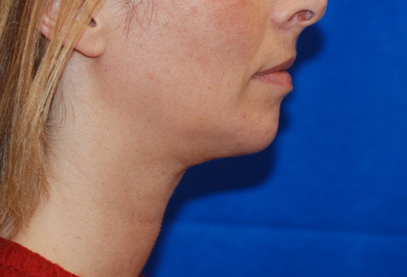 Chin Implant Before & After Gallery - Patient 83202842 - Image 8