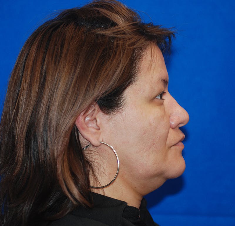 Kybella Before & After Gallery - Patient 83202851 - Image 7