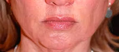 Chin Implant Before & After Gallery - Patient 119147376 - Image 1