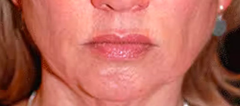 Chin Implant Before & After Gallery - Patient 119147376 - Image 1