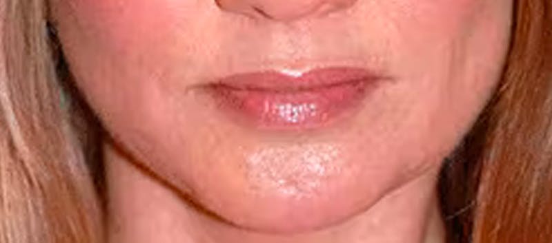 Chin Implant Before & After Gallery - Patient 119147376 - Image 2