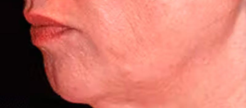 Chin Implant Before & After Gallery - Patient 119147376 - Image 3