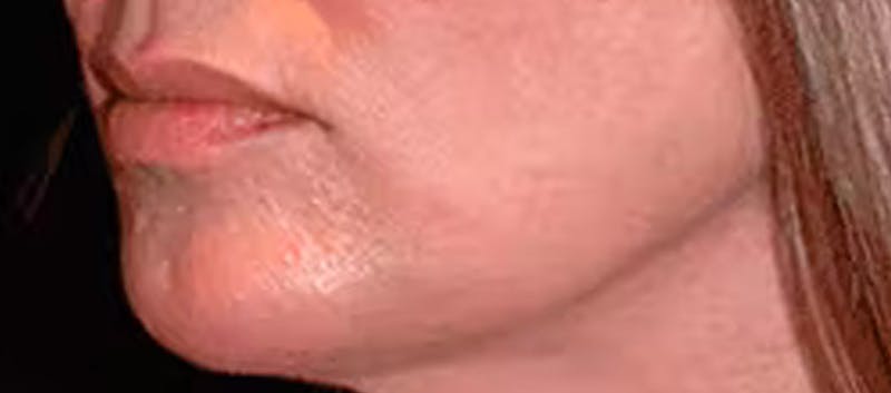 Chin Implant Before & After Gallery - Patient 119147376 - Image 4