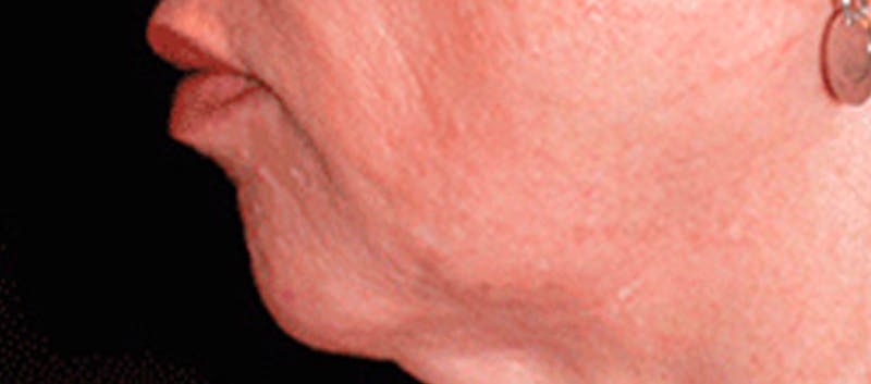 Chin Implant Before & After Gallery - Patient 119147376 - Image 5