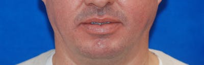 Chin Implant Before & After Gallery - Patient 108401353 - Image 1