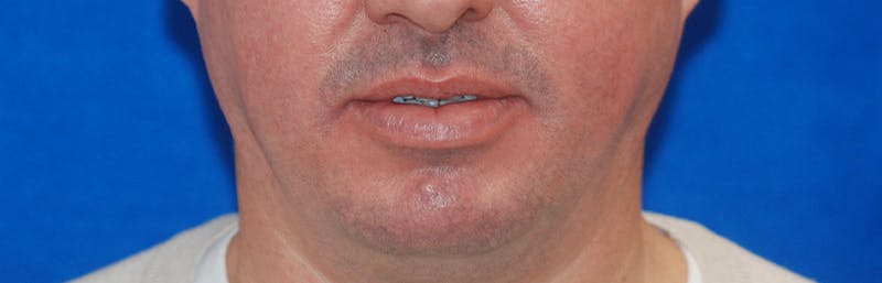 Chin Implant Before & After Gallery - Patient 108401353 - Image 1