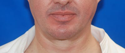 Chin Implant Before & After Gallery - Patient 108401353 - Image 2