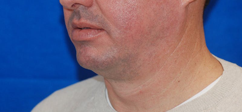 Chin Implant Before & After Gallery - Patient 108401353 - Image 3