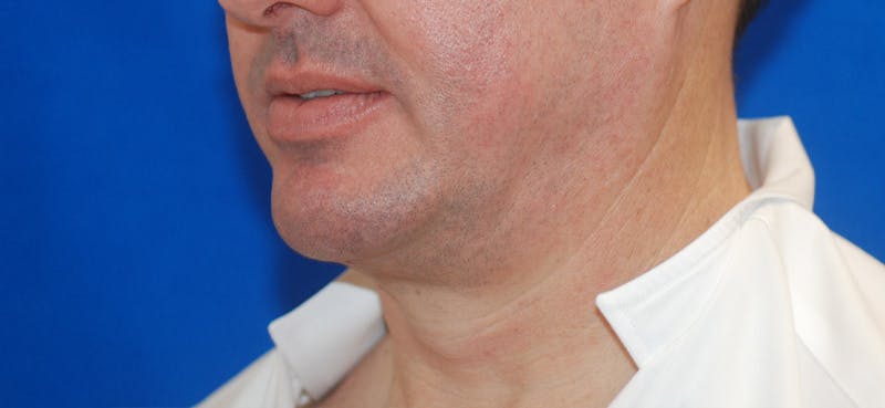 Chin Implant Before & After Gallery - Patient 108401353 - Image 4