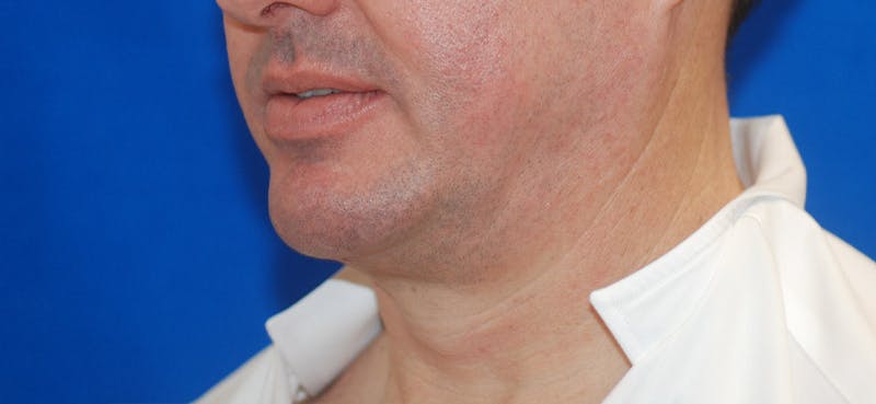 Chin Implant Before & After Gallery - Patient 108401353 - Image 4