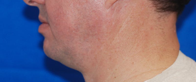 Chin Implant Before & After Gallery - Patient 108401353 - Image 5