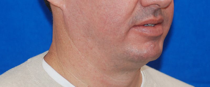 Chin Implant Before & After Gallery - Patient 108401353 - Image 7
