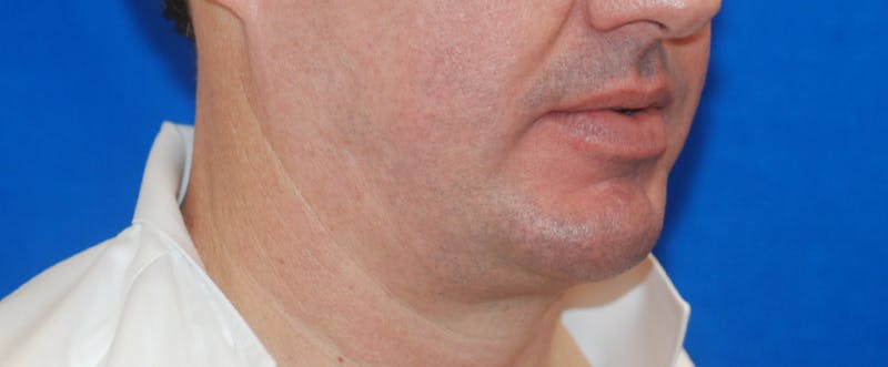 Chin Implant Before & After Gallery - Patient 108401353 - Image 8