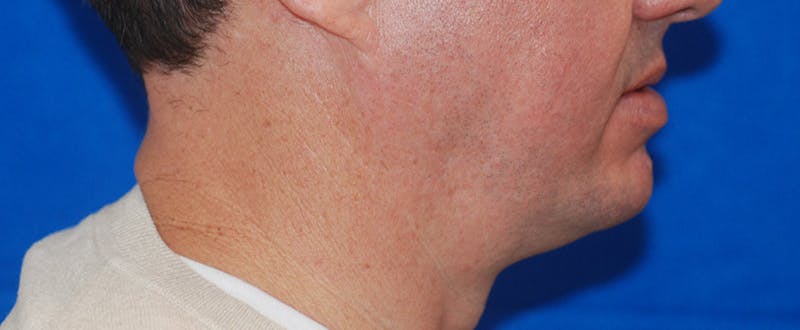 Chin Implant Before & After Gallery - Patient 108401353 - Image 9