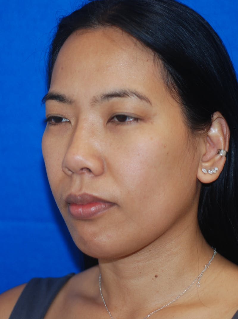 Chin Implant Before & After Gallery - Patient 148990958 - Image 4