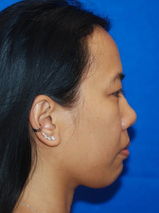 Rhinoplasty Before & After Gallery - Patient 148990950 - Image 6