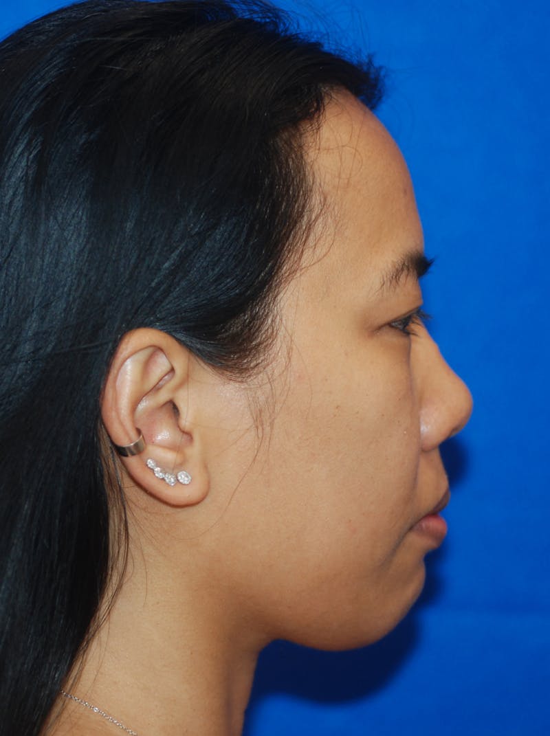 Chin Implant Before & After Gallery - Patient 148990958 - Image 6