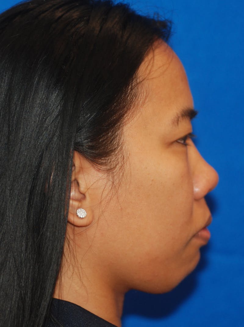Rhinoplasty Before & After Gallery - Patient 148990950 - Image 5