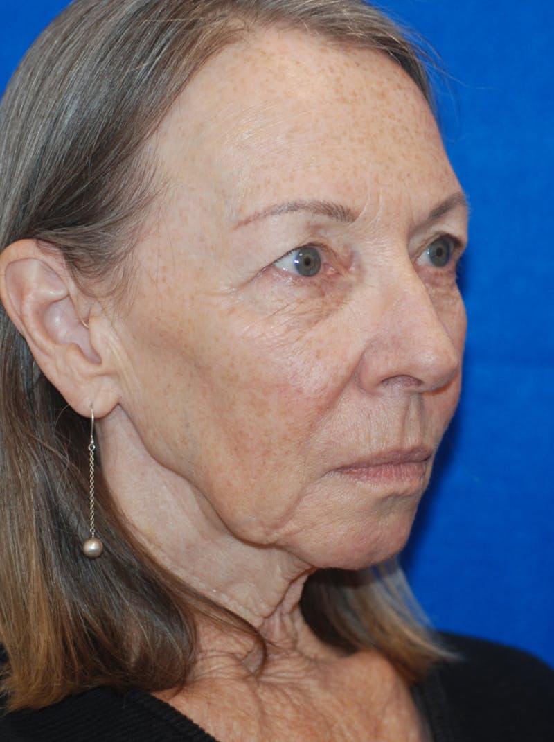 Facelift Before & After Gallery - Patient 148991011 - Image 1