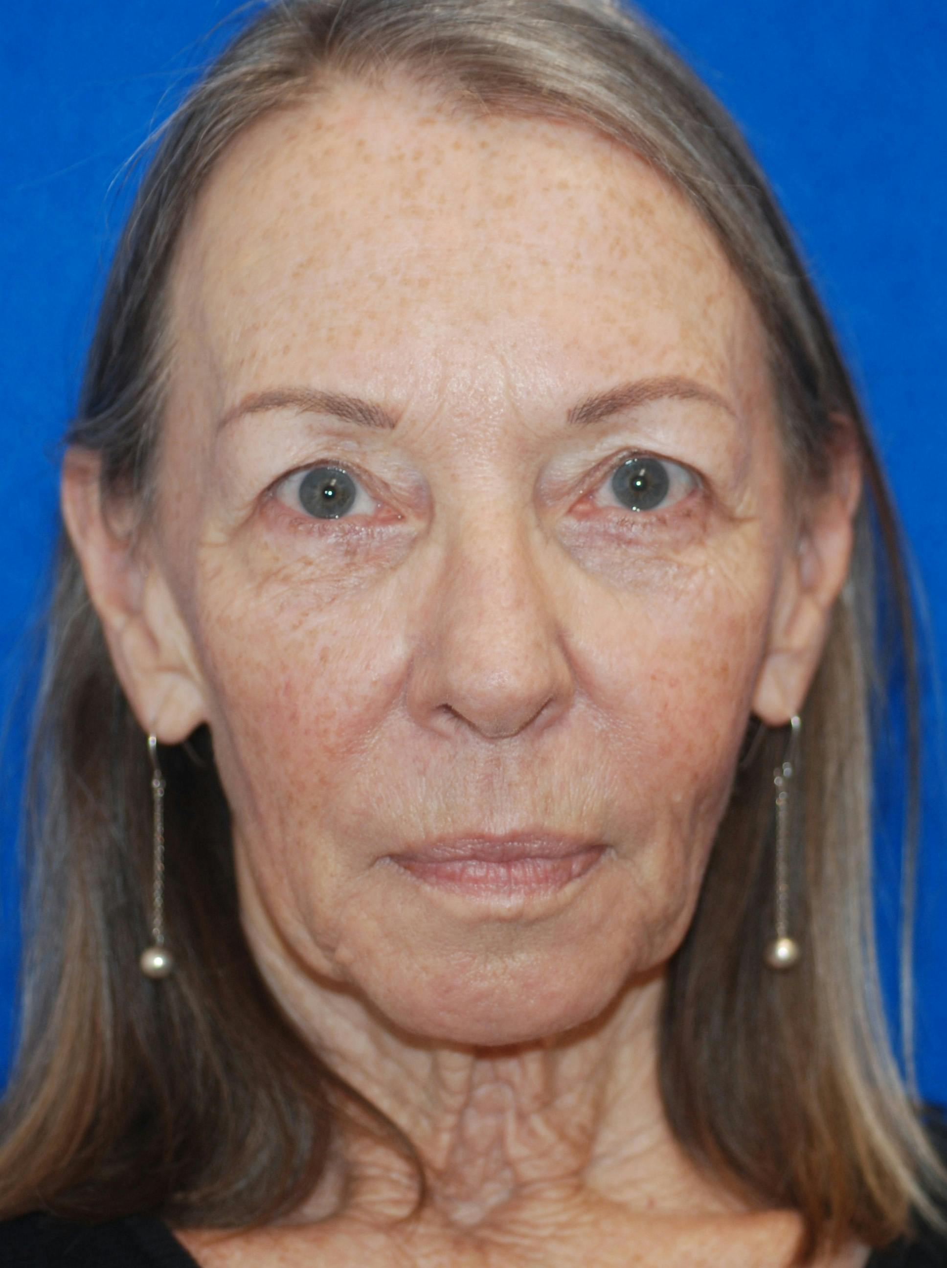 Eyelid Surgery Patient 71702036 Before & Afters