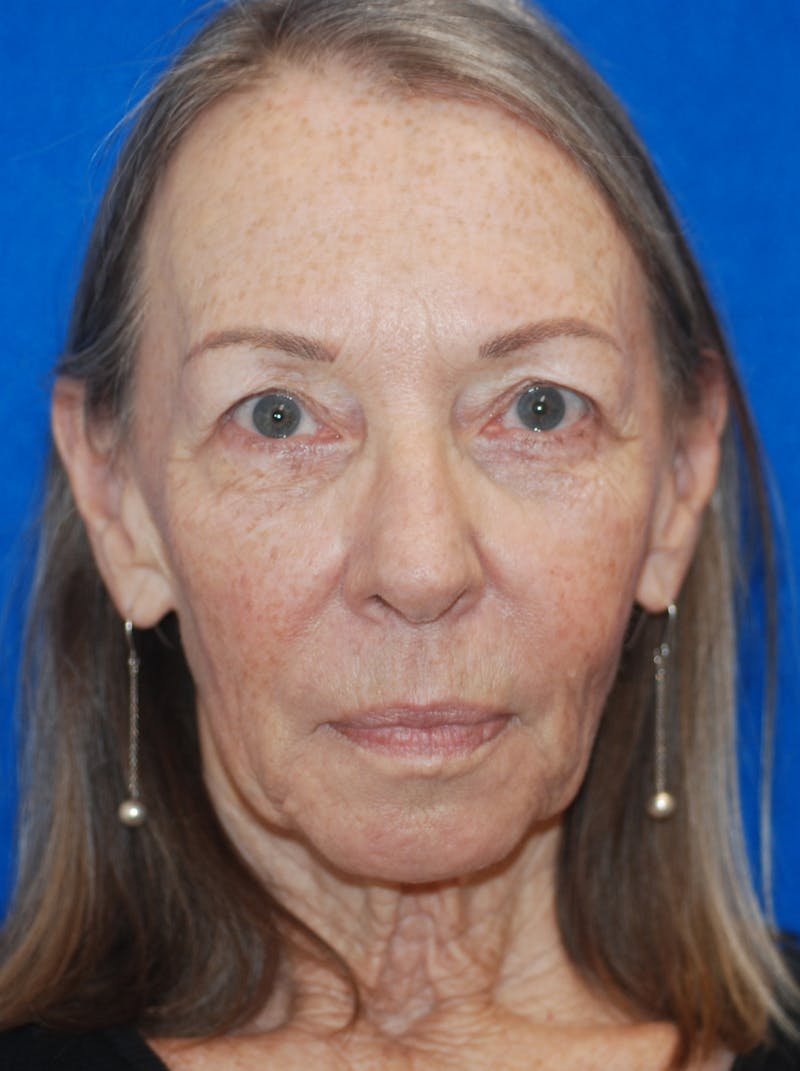 Facelift Before & After Gallery - Patient 148991011 - Image 3