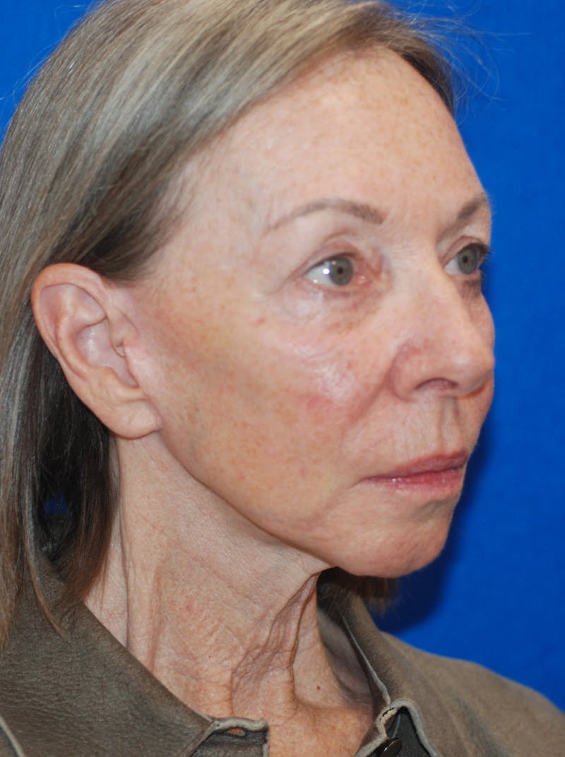 Eyelid Surgery Before & After Gallery - Patient 148991013 - Image 2