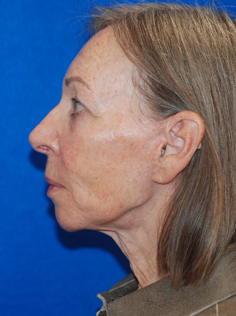 Eyelid Surgery Patient 148991013 After Left Side