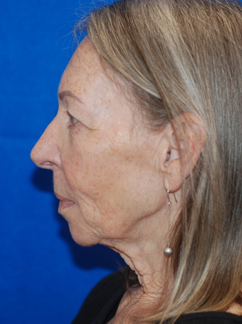 Facelift Before & After Gallery - Patient 148991011 - Image 5