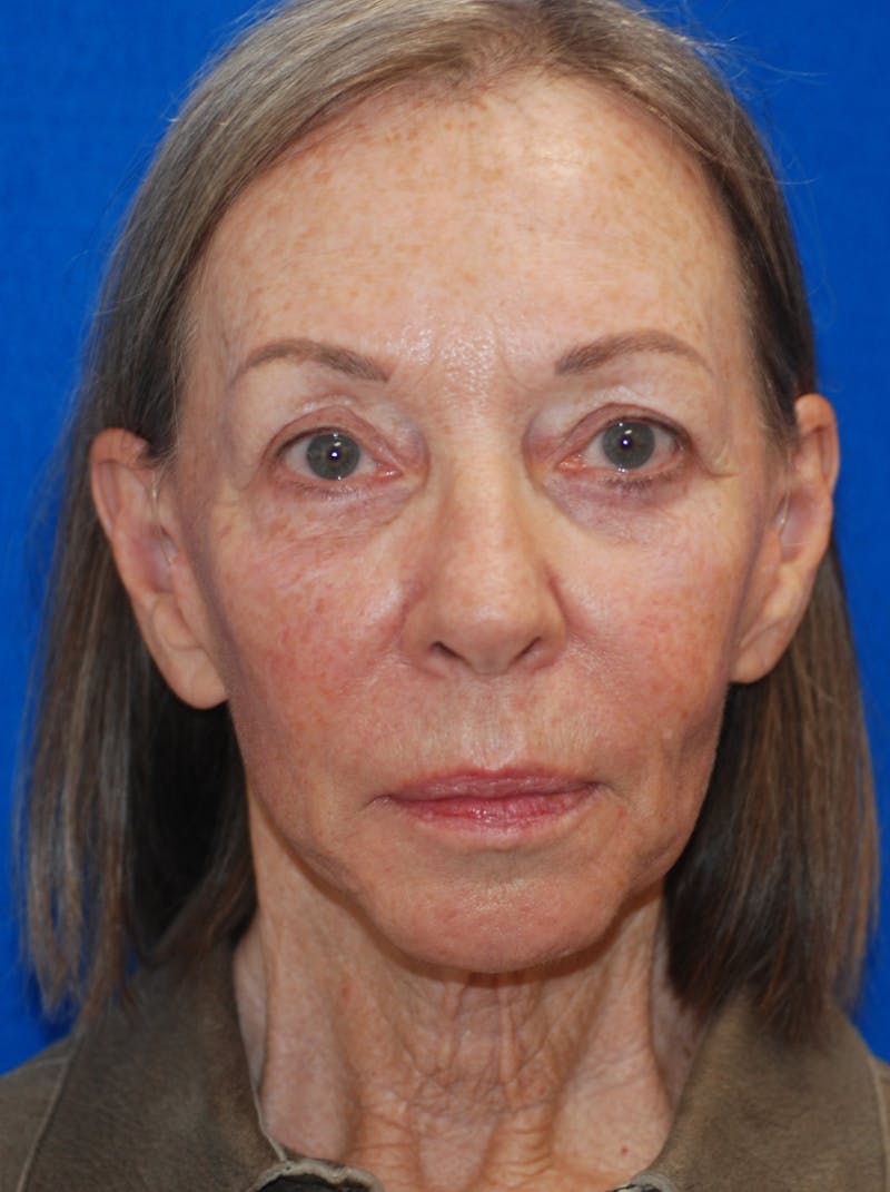Facelift Before & After Gallery - Patient 148991011 - Image 4