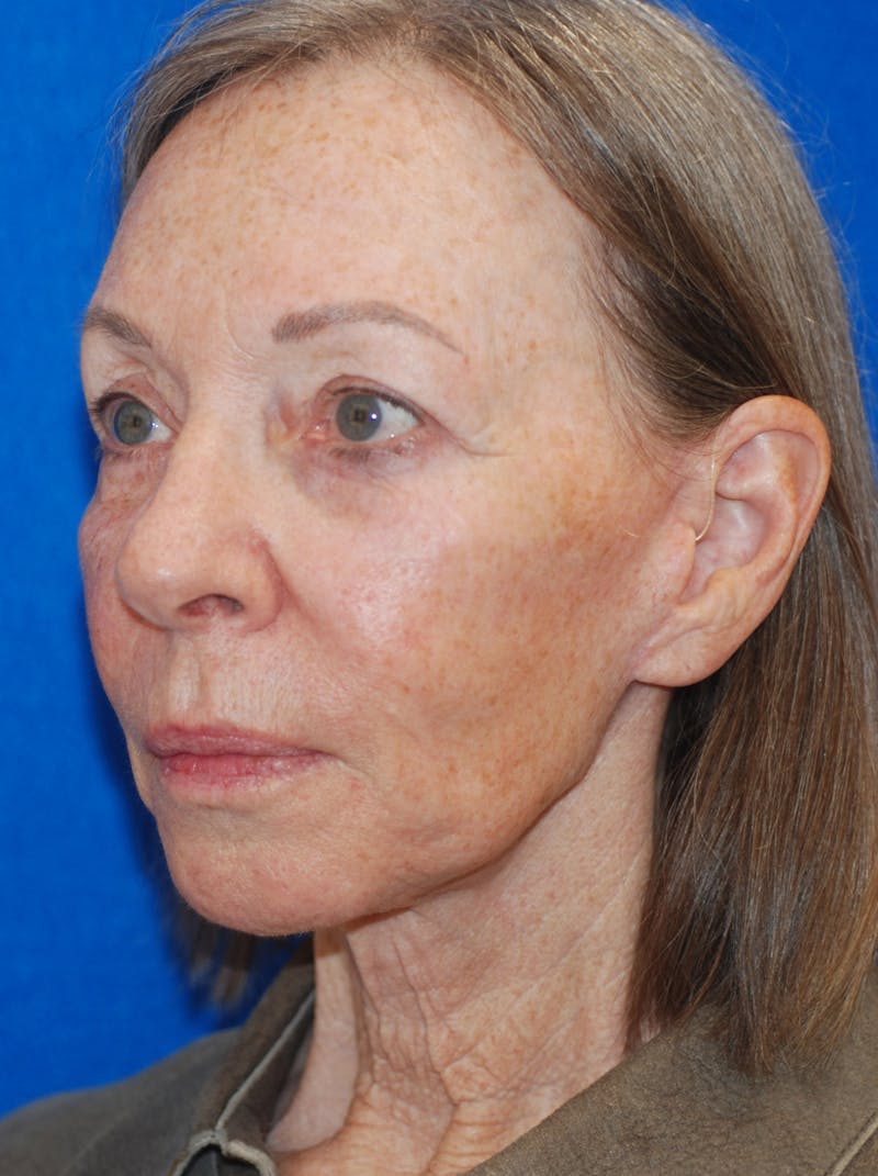 Eyelid Surgery Patient 148991013 After Left Angle