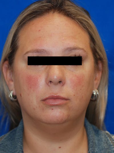 Microneedling with Exosomes Before & After Gallery - Patient 148991036 - Image 1