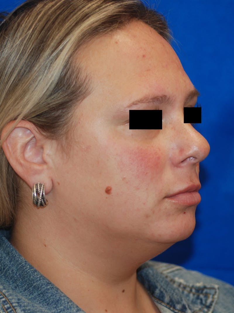 Chemical Peel Before & After Gallery - Patient 148991052 - Image 3
