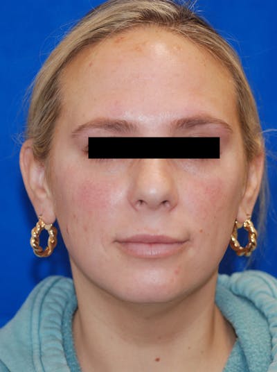 Chemical Peel Before & After Gallery - Patient 148991052 - Image 2