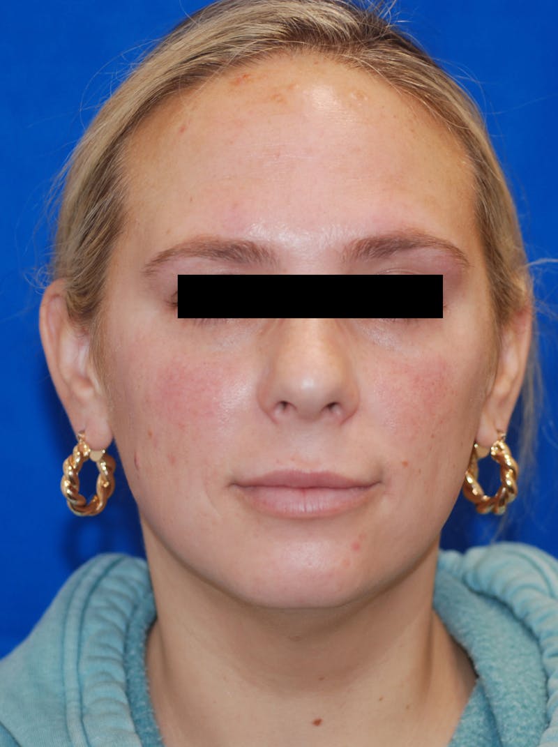 Chemical Peel Before & After Gallery - Patient 148991052 - Image 2