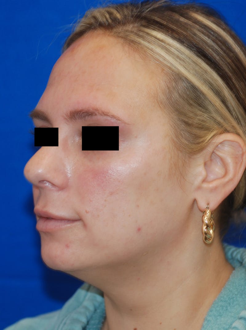 Microneedling with Exosomes Before & After Gallery - Patient 148991036 - Image 6