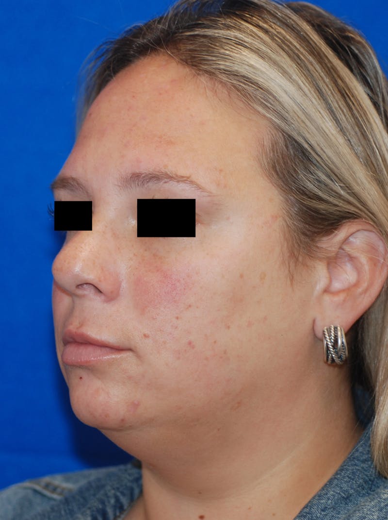 Microneedling with Exosomes Before & After Gallery - Patient 148991036 - Image 5
