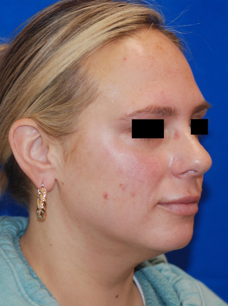 Microneedling with Exosomes Before & After Gallery - Patient 148991036 - Image 4