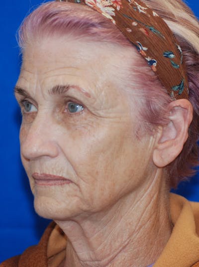 Facelift Before & After Gallery - Patient 148991086 - Image 1