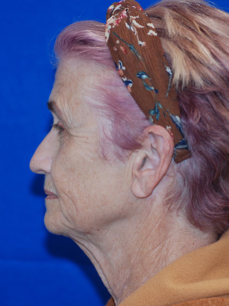 Facelift Before & After Gallery - Patient 148991086 - Image 3