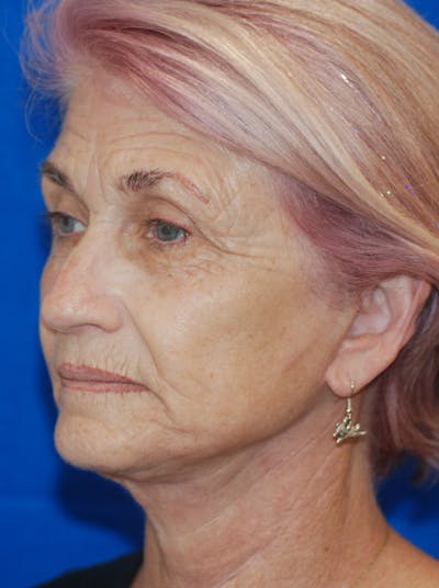 Facelift Before & After Gallery - Patient 148991086 - Image 2