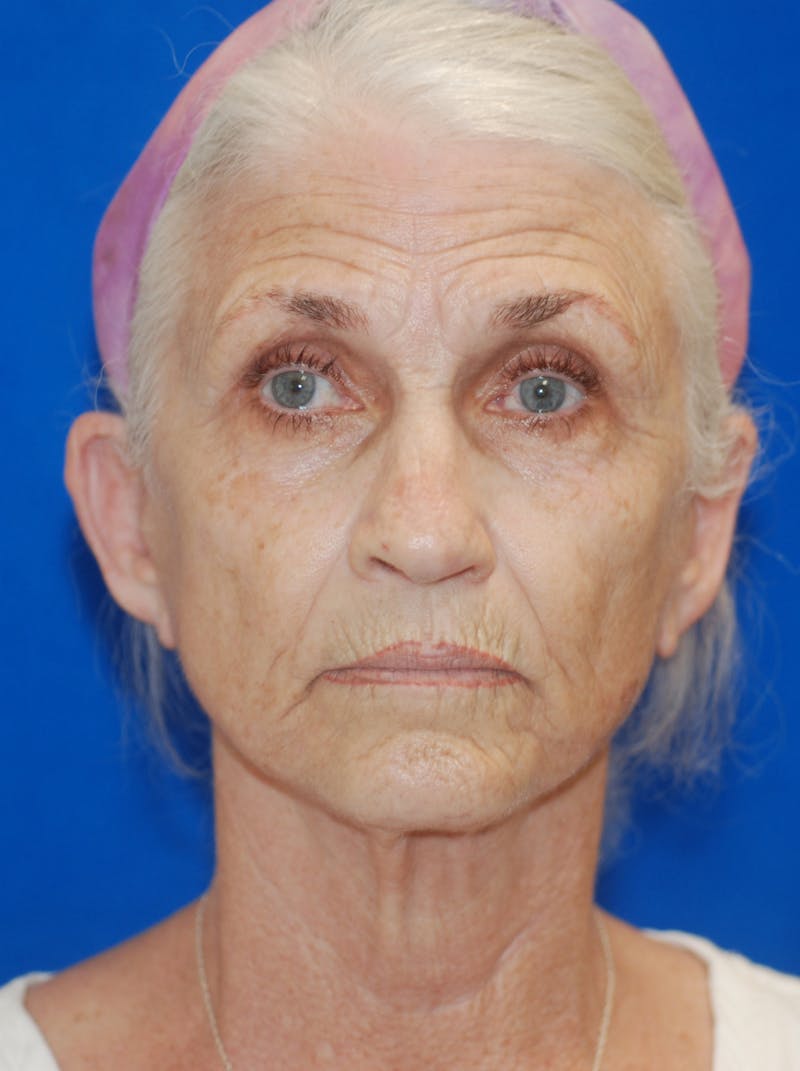 Facelift Before & After Gallery - Patient 148991086 - Image 6